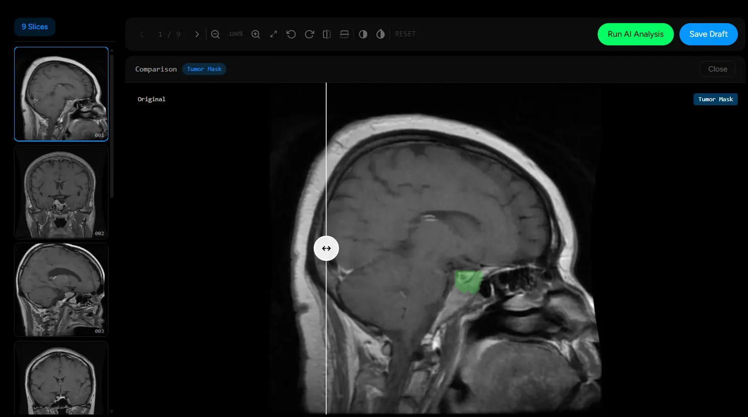 The IntelliDiag viewer showing MRI slices, comparing a slice with an AI tumour mask